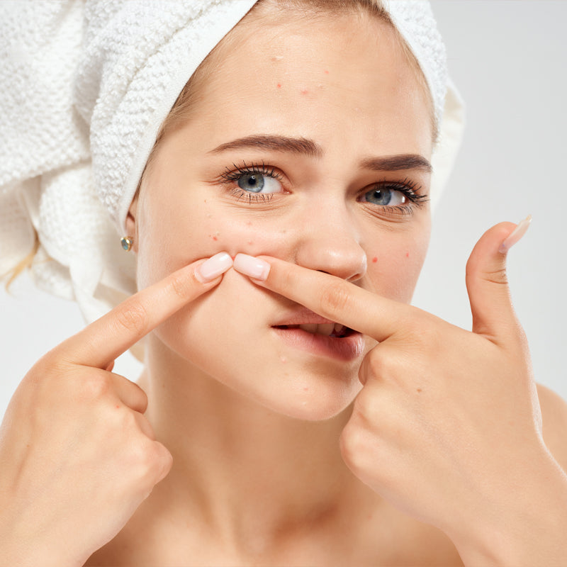 Struggling with Acne