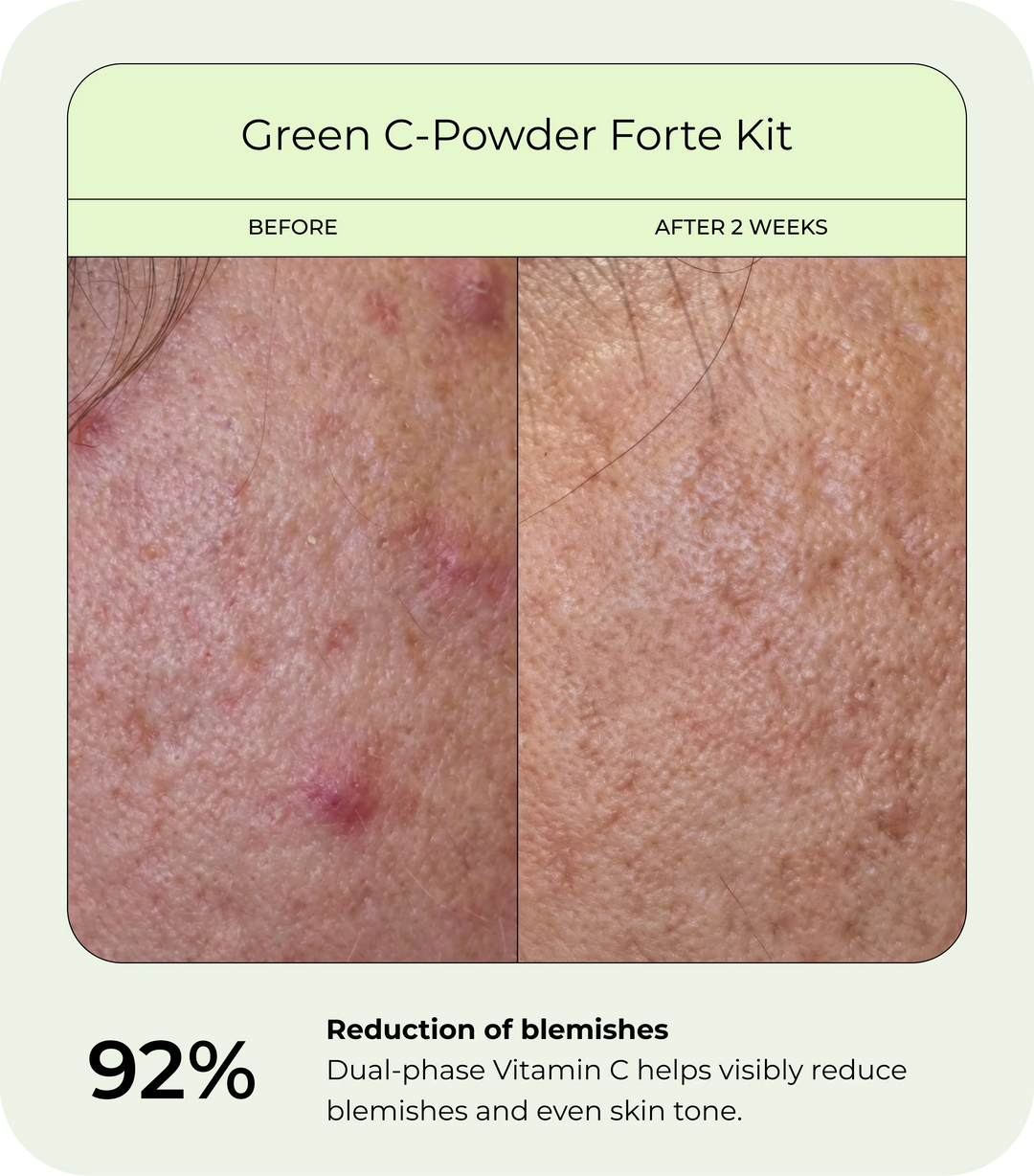 Before and after comparison of facial skin using DrJ SkinClinic Green C-Powder Forte Kit. Left image shows skin with visible blemishes and redness before use; right image shows smoother, more even-toned skin after two weeks.