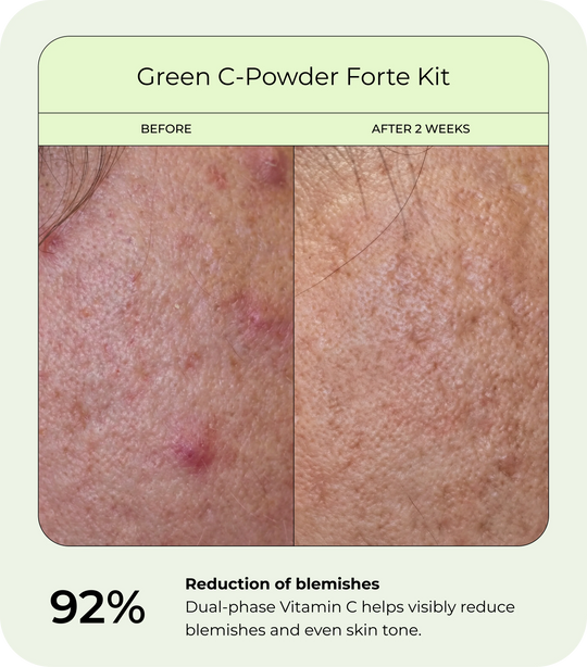 Before and after comparison of facial skin using DrJ SkinClinic Green C-Powder Forte Kit. Left image shows skin with visible blemishes and redness before use; right image shows smoother, more even-toned skin after two weeks.
